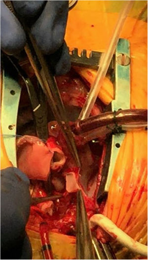 Imagen intraoperatoria de cirugía de Norwood en estadio i de la paliación en paciente con síndrome de corazón izquierdo hipoplásico. Hasta este punto, se ha extirpado el tejido ductal, reparado la coartación y dilatado la arteria pulmonar bajo perfusión cerebral y miocárdica selectiva. En la imagen, se aprecia como la aorta ascendiente diminuta se abre hasta la unión sinotubular, quedando lista para la anastomosis con la arteria pulmonar. Esta parte del procedimiento se realiza bajo perfusión cerebral selectiva.