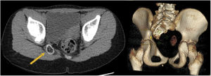 En la tomografía computarizada con reconstrucción 3D se muestra la malformación sacrocoxígea compleja: estructura ovalada calcificada aislada (flecha amarilla) con hipogenesia de hemisacro derecho y coxis.