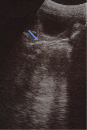 Ecografía pélvica mostrando una estructura lineal hiperecogénica en la luz vaginal (flecha azul).