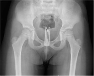 Radiografía simple de pelvis en la que se observa el cuerpo extraño.