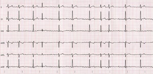 Electrocardiograma caso 1.