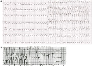 a) Electrocardiograma mostrando una taquicardia regular de QRS ancho, eje inferior-izquierdo, y morfología de bloqueo de rama izquierda; b) Electrocardiograma realizado durante la cardioversión eléctrica. Después del choque, el ritmo sinusal es restaurado.
