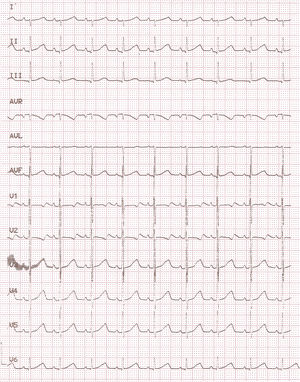 Electrocardiograma realizado 2h tras la cardioversión, mostrando ritmo sinusal con intervalo PR normal.