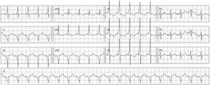 Electrocardiograma realizado 4h poscardioversión. Se distingue un patrón de preexcitación con onda delta positiva en las derivaciones D-I, aVL, y en todas las precordiales, y negativa en cara inferior, sugiriendo posible vía postero-septal izquierda. Nótese el cambio de eje QRS a superior-izquierdo.