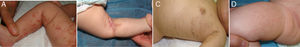 Estadios cutáneos. A)Vesicular (caso 4). B)Verrugoso o liquenoide (caso 5). C)Hiperpigmentado (caso 4). D)Hipopigmentado (caso 1).