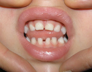 Dientes cónicos (caso 11).