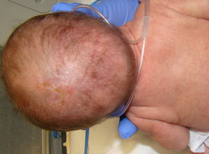 Afectación cutánea en cuero cabelludo con placa alopécica (caso 5).
