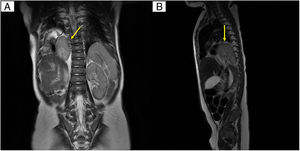 Resonancia magnética toracoabdominal. Proyecciones: A) coronal y B) sagital, que muestran la localización intratorácica del riñón derecho (flechas amarillas).