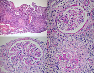Estudio histopatológico de biopsia renal. Se observa extensa afectación glomerular con fibrosis y necrosis segmentaria. Tinción de hematoxilina-eosina.