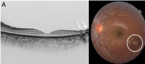 A) Imagen obtenida mediante OCT; se observa hipertrofia del epitelio pigmentario y ausencia de capas estructuradas en la retina. Depósitos prerretinianos hiperreflectivos como estalagmitas (flecha). B) Imagen de fondo de ojo con cicatriz coriorretiniana típica (círculo).