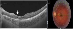 A) Imagen OCT. Se observan espacios quísticos en la capa interna de la retina. Son frecuentes los espacios quísticos en pacientes con toxoplasmosis, se consideran una complicación (quistes llenos de parásitos o signos de inflamación o exudación local). B) Fondo de ojo. Se observa la cicatriz coriorretiniana paramacular nasal coincidente con la imagen de OCT.