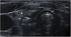 Imagen de ecografía cervical que muestra la presencia de aire atípico posterior al lóbulo tiroideo derecho, sugestivo de complicación. Flecha simple: tráquea. Estrella: lóbulo tiroideo derecho. Flecha doble: absceso tiroideo posterior al lóbulo tiroideo derecho.
