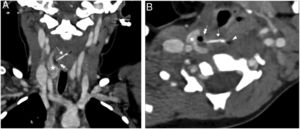 Imagen de la TC cervical con contraste intravenoso en reconstrucción coronal (A) y axial (B) donde se identifica un cuerpo extraño hiperdenso lineal que se dirige desde el esófago al tiroides, identificando un absceso con una burbuja de aire atípico en su interior, adyacente al lóbulo tiroideo derecho. Flecha simple: espina de pescado. Estrella: lóbulo tiroideo derecho. Flecha doble: absceso tiroideo con burbuja de aire atípico.