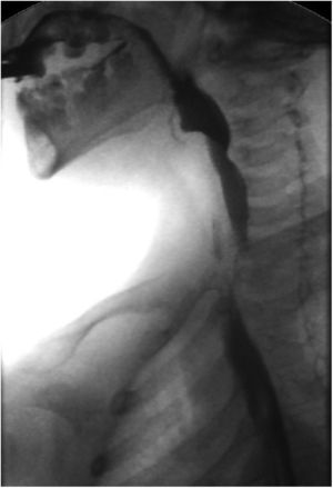 Tránsito esófago-gástrico posquirúgico: indentación a nivel de la unión faringoesofágica residual, pero con mejoría clara con respecto al estudio previo.