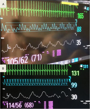 Monitor correspondiente a niño de 5 años con estado asmático con hipercapnia de 79mmHg a su llegada al hospital, que se trató con éxito con ventilación no invasiva. El pulsioxímetro empleado es Philips, con tecnología FAST (fourier artifact suppression techonology). Nótese que se ha variado la velocidad de barrido de la frecuencia respiratoria, la misma que la de la saturación transcutánea de oxígeno (25mm/h). La información que aporta tanto de frecuencia respiratoria como de saturación de oxígeno son simultáneas (imprescindible para valorar el pulso paradójico). A) Una hora tras el inicio de la ventilación no invasiva, se observa pulsus paradoxus, marcada variación respirofásica de la amplitud de onda de pulso (menor en inspiración). Nótese además que, pese a la adecuada onda registrada, la frecuencia cardiaca por onda de pulso no corresponde con la del electrocardiograma, probablemente por la baja amplitud en la inspiración. B) Monitor correspondiente a 17 h más tarde, en el que ya no se aprecia pulsus paradoxus y la frecuencia cardiaca por onda de pulso sí coincide con la del electrocardiograma. El vídeo suplementario permite apreciar mejor los detalles anteriormente descritos.