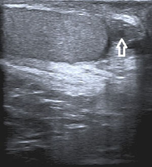 La ecografía escrotal mostró un nódulo heterogéneo de 13×12mm isoecoico al testículo con zonas hipoecoicas. La lesión tenía una apariencia quística.