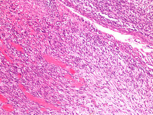 Proliferación neoplásica constituida por células estromales inmaduras, dispuestas sobre fondo laxo. En la mitad superior derecha de la imagen se puede observar el uréter englobado por la neoplasia (H&E, ×10).