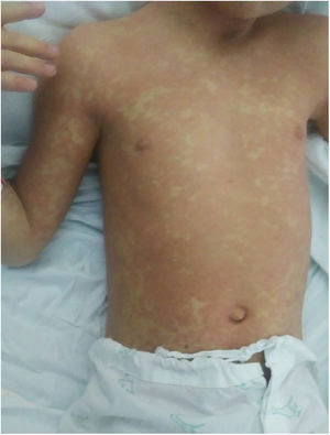 Exantema maculopapular eritematoso, confluente, en el paciente 1.