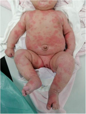 Exantema urticariforme en la paciente 2.