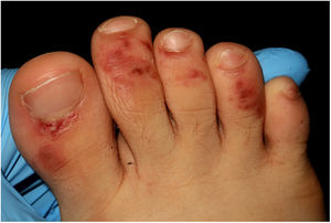 Máculas violáceas purpúricas en el dorso de los dedos de los pies.