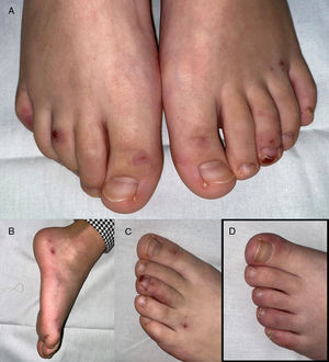 Lesiones acrales perniosiformes tipo purpúricas en la paciente 1. A y B) Pápulas purpúricas de aspecto hemorrágico, redondeadas y distribuidas simétricamente en falanges distales de dedos y talones de ambos pies. C) Detalle de la lesión de aspecto isquémico-hemorrágico en región subungueal del tercer dedo del pie izquierdo. D) Lesiones acrales en la madre de la paciente 1, el mismo día de la consulta, de similares características clínicas, pero con menor componente hemorrágico.