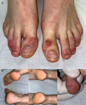 Lesiones acrales perniosiformes tipo eritema multiforme en el paciente 2. A-C) Pápulas eritemato-violáceas edematosas, redondeadas y distribuidas simétricamente en falanges distales de dedos, talones y plantas de ambos pies. D) Detalle de la lesión en la que se aprecia tendencia a la formación de ampollas sobre algunas de las pápulas.