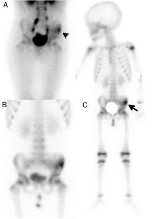 Gammagrafía ósea de pelvis y cuerpo completo en 3 fases. En la fase precoz, a los 5min de la inyección del radiotrazador, se visualiza un aumento de la vascularización en la hemipelvis izquierda (A, punta de flecha), que en la fase tardía, a las 3h postinyección, se correspondió con actividad osteoblástica en la pala ilíaca (B y C, flecha).