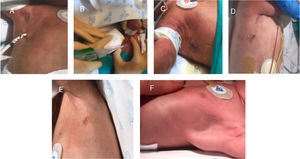 A-E) Caso 2-B: A) Drenaje pleural derecho. B) Retirada del drenaje y sutura mediante adhesivo líquido. C) 24h posteriores a la sutura. D) 48h posteriores. E y F) Caso 1: E) Una semana posterior a la sutura. F) 30 días posterior.