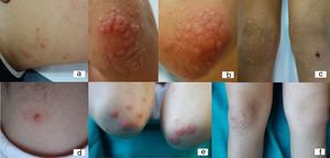 Paciente 3: niño de 10 años con reacción al síndrome de Gianotti-Crosti-like a Molluscum contagiosum; 1a) Lesiones inflamadas de molusco contagioso en el muslo; 1b) Pápulas edematosas inflamatorias rojizas en los codos; 1c) Pápulas rosáceas en las rodillas, fenómeno de Koebner secundario al rascado. Paciente 1: niña de 8 años con reacción al síndrome de Gianotti-Crosti-like a Molluscum contagiosum; 2a) Molusco contagioso inflamado en la región cervical; 2b y c) Pápulas edematosas rojizo-rosáceas en codos y rodillas.