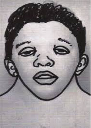Ilustración esquemática del aspecto facial típico en el síndrome de Noonan.