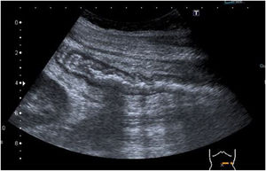Ecografía abdominal: engrosamiento parietal difuso de colon descendente desde ángulo esplénico hasta sigma con hiperecogenicidad de la grasa adyacente y adenopatías regionales.
