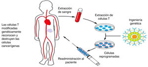 Producción y administración de células CART. Se obtienen los linfocitos del paciente mediante leucoaféresis. Ex vivo se separan los linfocitos T, se expanden y se modifican genéticamente para que expresen un receptor de células T quimérico (Chimeric antigen receptor) que reconoce un antígeno tumoral (CD19 en el caso de las CART19) y se reinfunden después al paciente.