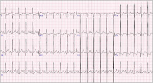 Ecocardiograma a los 6 meses: signos de isquemia subendocárdica con la presencia de onda Q profunda en iii.