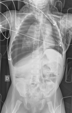 Imagen mediante radiografía portátil de tórax y abdomen en la que se aprecia neumotórax derecho a tensión, neumotórax izquierdo, enfisema subcutáneo cervical y en pared lateral del tórax y neumorretroperitoneo.