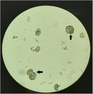 Cristales de sulfadiazina en el sedimento urinario vistos al microscopio (×400 aumentos).