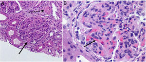 Biopsia renal. Tinción hematoxilina eosina. A) Glomérulos hiperlobulados con importante proliferación (flecha continua). Arteriola ocluida por material fibrinoide (flecha discontinua). B) Capilar glomerular ocluido por trombos de fibrina.