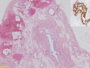 Imágenes de anatomía patológica. Fotomicrografía (magnificación original, ×4; tinción hematoxilina-eosina) en la que se reconoce la cavidad de la masa presacra revestida por epitelio ependimario. En el recuadro superior derecho, fotomicrografía (magnificación original, ×10; tinción GFAP) que demuestra tejido glial GFAP positivo rodeando la cavidad revestida por epitelio ependimario. Los hallazgos son compatibles con meningocele.