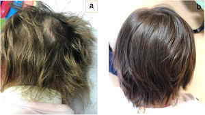 a. Decoloración verdosa del cabello durante el tratamiento. b. Normalización del color en la actualidad.