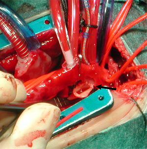 Avance aórtico: anastomosis término-lateral entre aorta descendente y la base de arco aórtico, ampliando el arco aórtico.