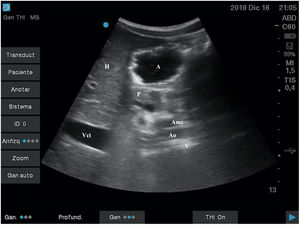 Antro con contenido líquido en DS. A: antro; Ams: arteria mesentérica superior; Ao: aorta; H: hígado; P: páncreas; V: vértebra; Vci: vena cava inferior.