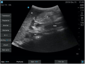 Antro con contenido sólido en DS. A: antro; Ams: arteria mesentérica superior; Ao: aorta; H: hígado; P: páncreas; V: vértebra.