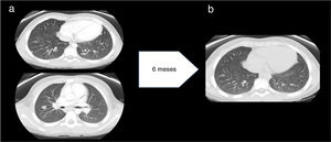 a) Antes del tratamiento con anti-TNF-α: múltiples nódulos, bien definidos, de localización subpleural, periféricos y parenquimatosos con tamaño máximo 11 mm. No se observan signos de fibrosis pulmonar. Hallazgos compatibles con sarcoidosis pulmonar estadio 2. b) Después del tratamiento con anti-TNF-α: disminución significativa en el número y tamaño de los nódulos pulmonares.
