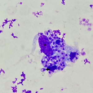 Microscopia óptica. Se aprecia un macrófago con su núcleo (asterisco) y un citoplasma que contiene en su interior múltiples amastigotes de Leishmania sp. Los amastigotes poseen un núcleo (flecha negra) y un cinetoplasto (flecha blanca) (Giemsa, x1.000).