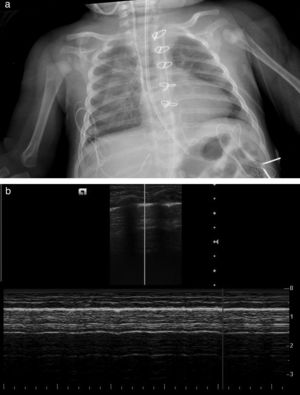 a) Radiografía de tórax donde se aprecia línea sugestiva de neumotórax derecho. b) Imagen ecográfica de Modo M donde se visualiza deslizamiento pleural en forma de signo de la orilla de mar que descarta neumotórax.