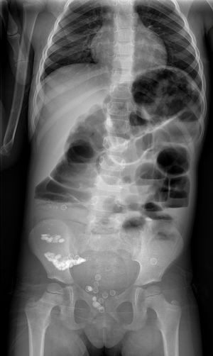Radiografía de abdomen. Niveles hidroaéreos e imágenes redondeadas hiperdensas tanto en región ileocecal como en ampolla rectal.