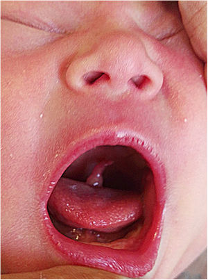 Banda oral, de consistencia carnosa que se extiende desde el tercio posterior de la base de la lengua hacia el paladar blando.