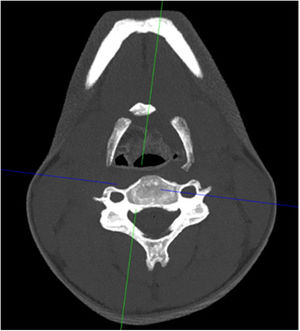 Visión de la fractura de hioides en la tomografía computarizada.
