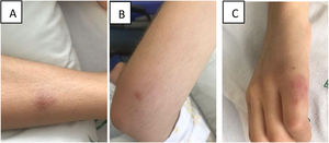 Lesiones nodulares a nivel pretibial (A), de codo derecho (B) y de 5.° dedo de la mano izquierda (C).