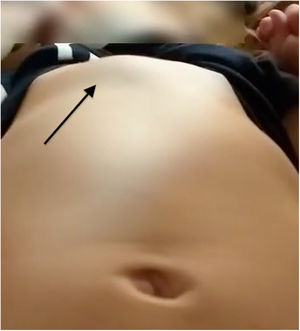 Tumoración de consistencia sólida en tercio inferior del esternón (señalada con una flecha).