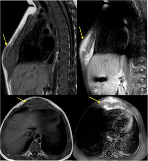 RM T1 y T1 con gadolinio, cortes sagital y axial donde se observa una lesión de partes blandas alrededor del esternón distal con captación de contraste.